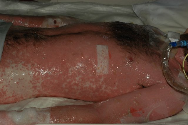 24 Year old male in early stage of Toxic Epidermal Necrolysis Syndrome with severe Ocular involvement. Approximately 4 days into reaction. (11)